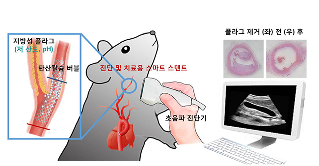 진단 및 치료용 스마트 스텐트 모식도.